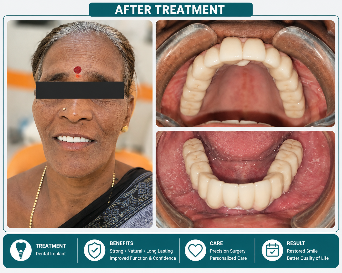 After dental implant treatment at J.V. Dental