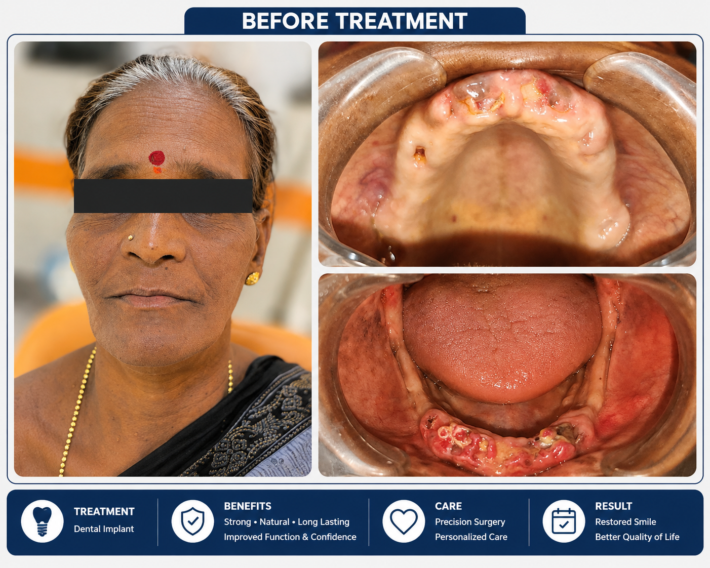Before dental implant treatment at J.V. Dental