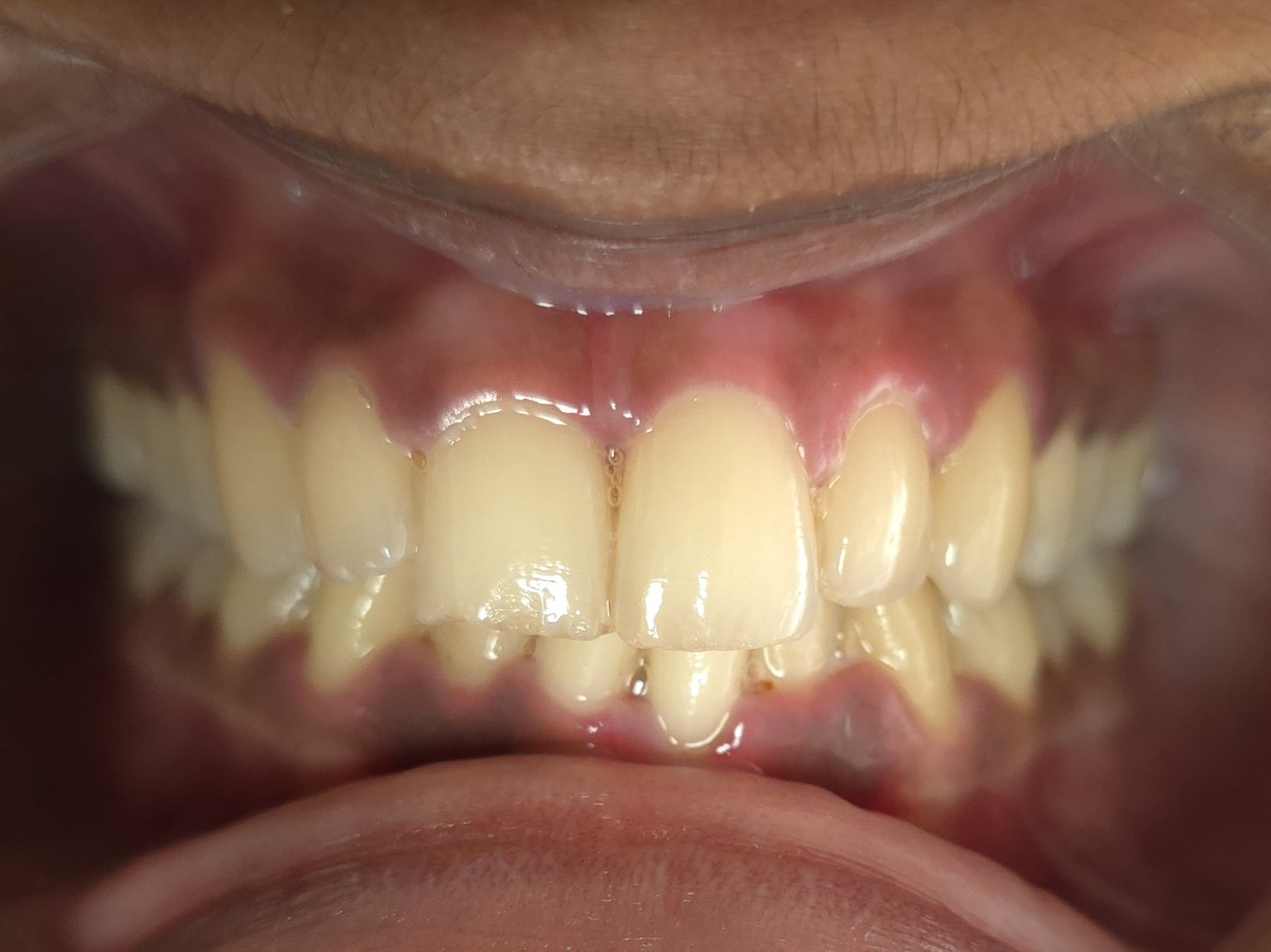 After laser treatment for gum infection