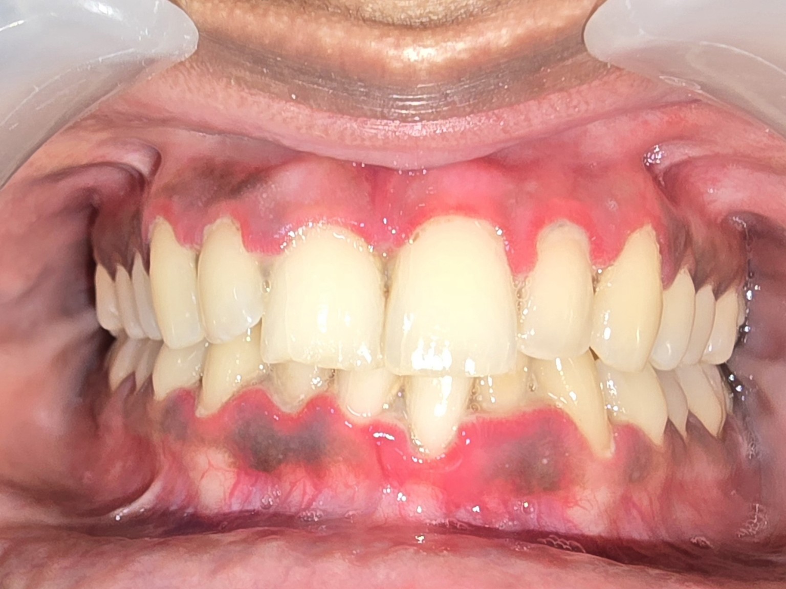 Before laser treatment for gum infection