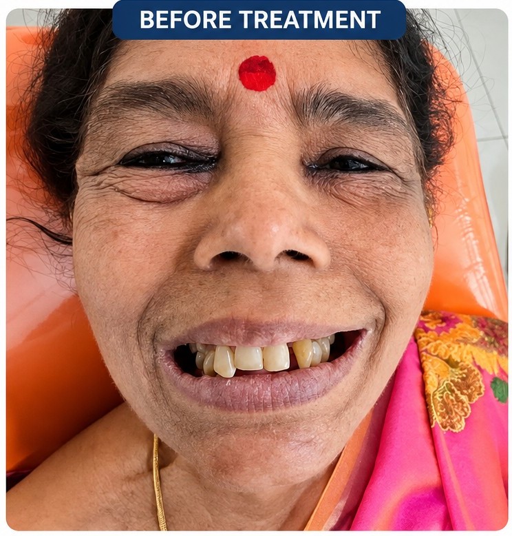 Smile Designing Before Treatment at J.V. Dental