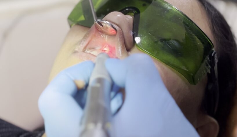 Dental Laser