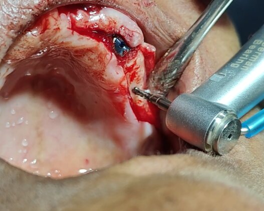 Dental Implants